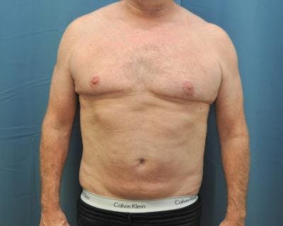 Male Breast Reduction Before & After Gallery - Patient 120195676 - Image 2