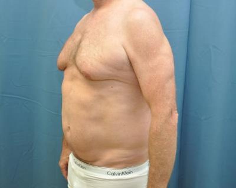 Male Breast Reduction Before & After Gallery - Patient 120195676 - Image 3