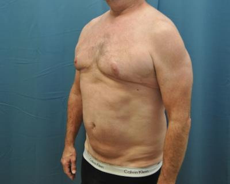 Male Breast Reduction Before & After Gallery - Patient 120195676 - Image 4