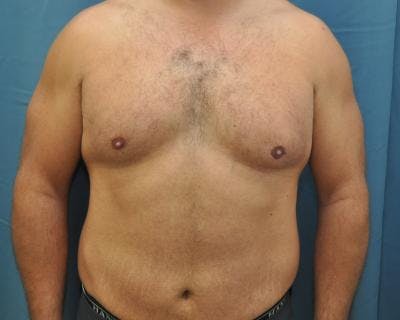 Male Breast Reduction Gallery - Patient 120195678 - Image 1