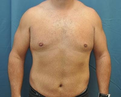 Male Breast Reduction Before & After Gallery - Patient 120195678 - Image 2