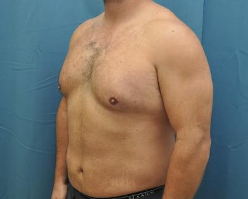 Male Breast Reduction Gallery - Patient 120195678 - Image 3