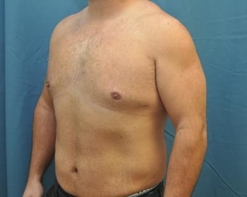 Male Breast Reduction Before & After Gallery - Patient 120195678 - Image 4