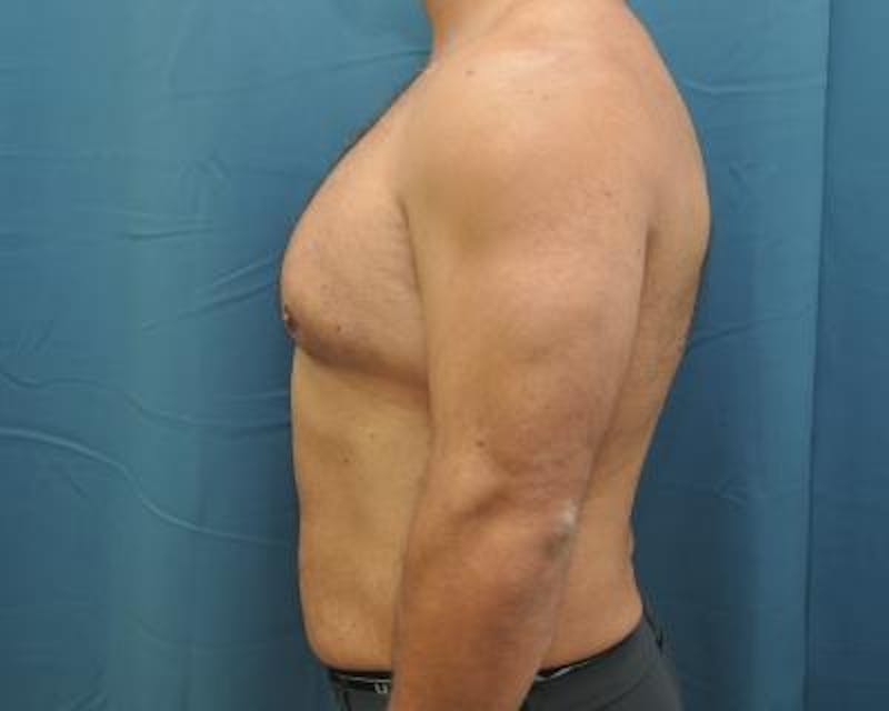 Male Breast Reduction Before & After Gallery - Patient 120195678 - Image 5