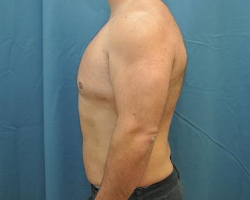 Male Breast Reduction Before & After Gallery - Patient 120195678 - Image 6