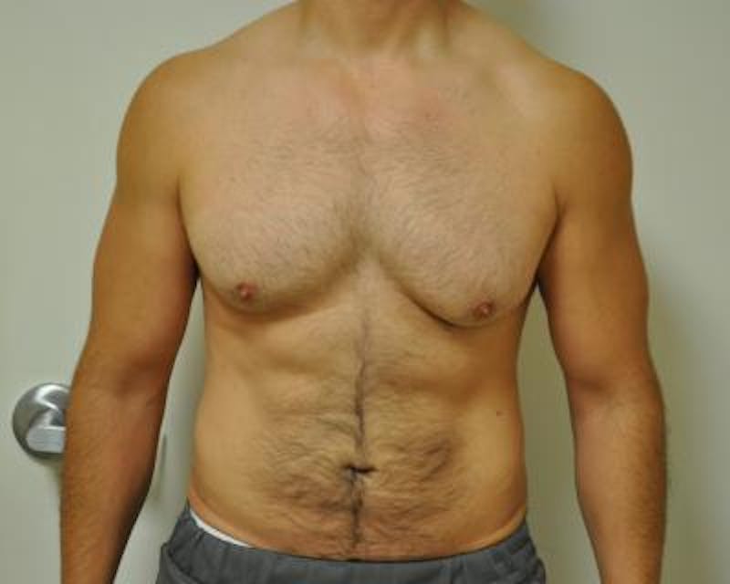 Male Breast Reduction Before & After Gallery - Patient 120195679 - Image 1