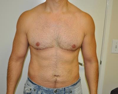 Male Breast Reduction Gallery - Patient 120195679 - Image 2