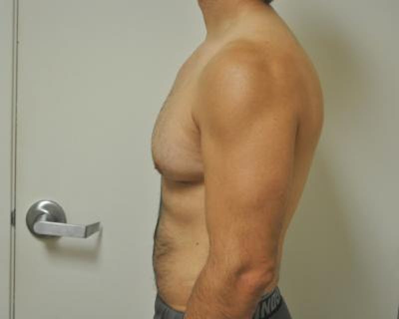 Male Breast Reduction Gallery - Patient 120195679 - Image 3