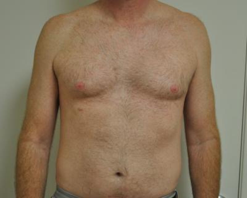 Male Breast Reduction Gallery - Patient 120195682 - Image 1