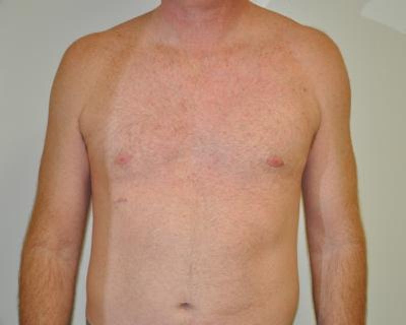 Male Breast Reduction Before & After Gallery - Patient 120195682 - Image 2