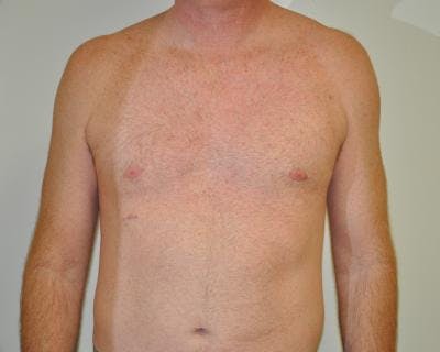 Male Breast Reduction Gallery - Patient 120195682 - Image 2