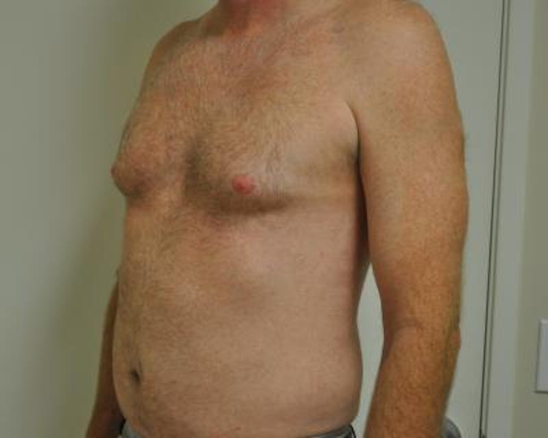 Male Breast Reduction Gallery - Patient 120195682 - Image 3