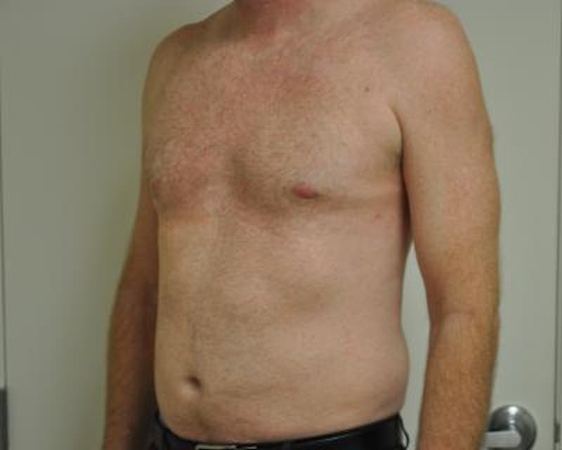 Male Breast Reduction Before & After Gallery - Patient 120195682 - Image 4