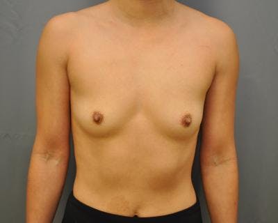 Breast Augmentation Before & After Gallery - Patient 120345721 - Image 1