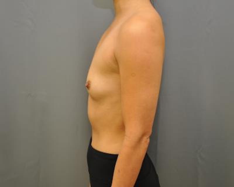 Breast Augmentation Before & After Gallery - Patient 120345721 - Image 3