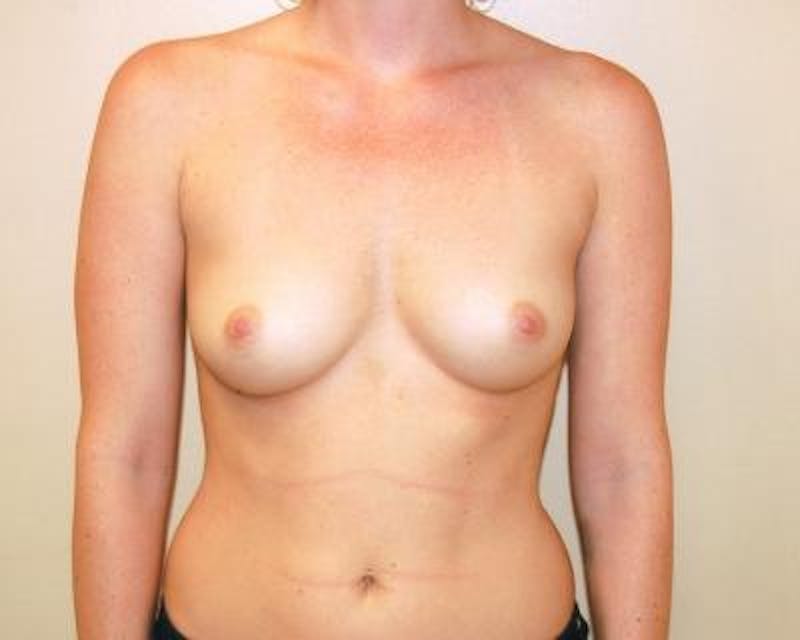 Breast Augmentation Before & After Gallery - Patient 120345730 - Image 1