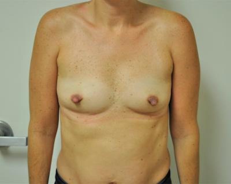 Breast Augmentation Before & After Gallery - Patient 120345770 - Image 1