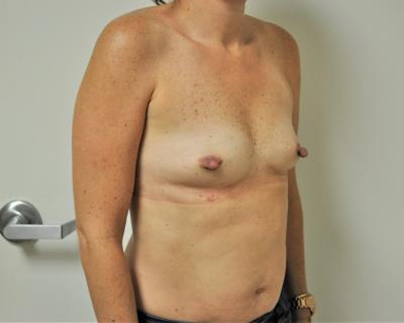 Breast Augmentation Before & After Gallery - Patient 120345770 - Image 3