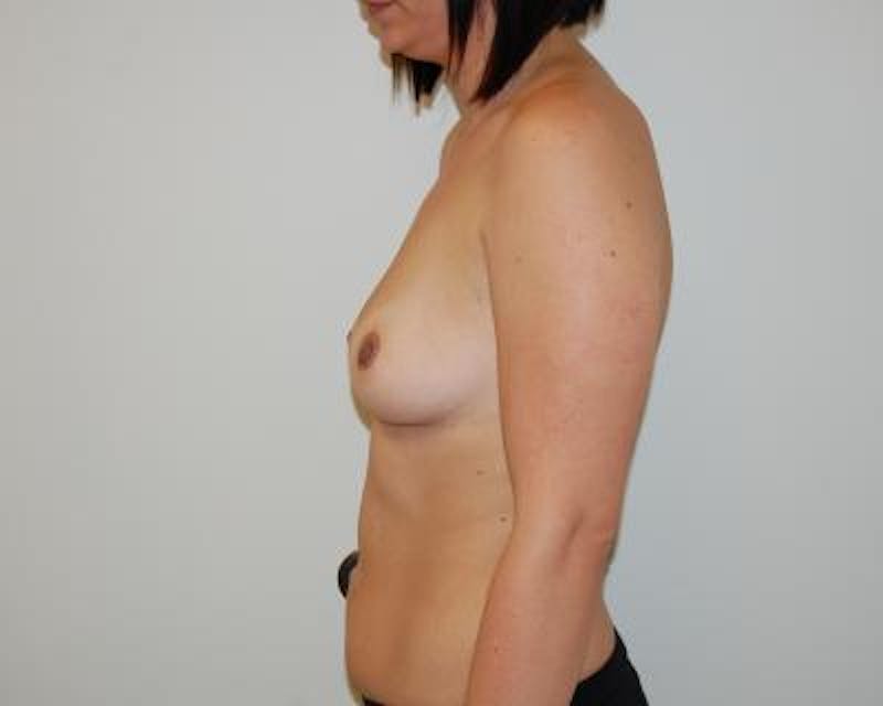 Breast Augmentation Gallery - Patient 120345789 - Image 3