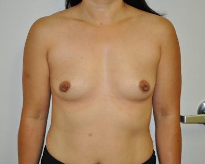Breast Augmentation Before & After Gallery - Patient 120345797 - Image 1