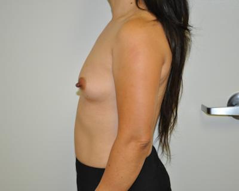 Breast Augmentation Gallery - Patient 120345797 - Image 3
