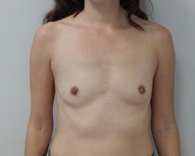 Breast Augmentation Before & After Gallery - Patient 120345810 - Image 1