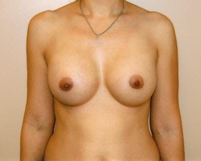 Breast Augmentation Before & After Gallery - Patient 120345870 - Image 2