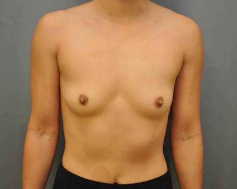 Breast Augmentation Gallery - Patient 120345881 - Image 1