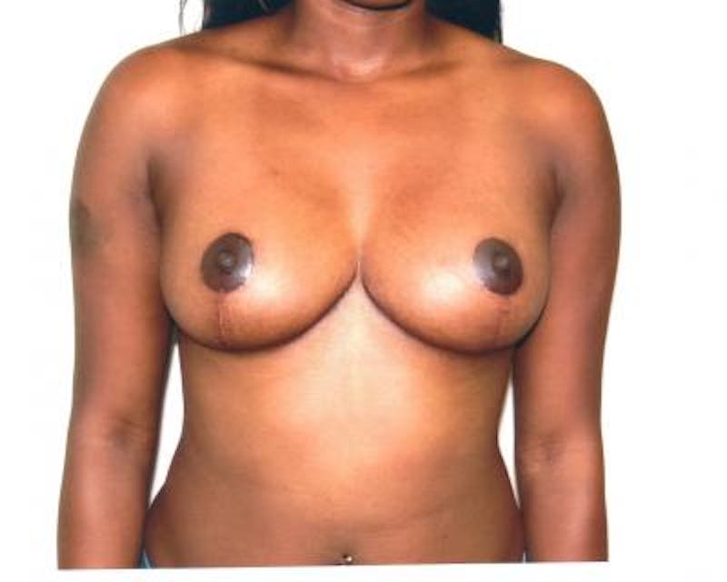 Breast Lift Before & After Gallery - Patient 120345954 - Image 2