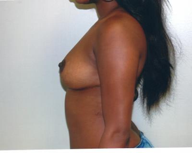 Breast Lift Before & After Gallery - Patient 120345954 - Image 4