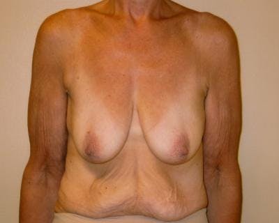 Breast Augmentation With Lift Before & After Gallery - Patient 120346191 - Image 1