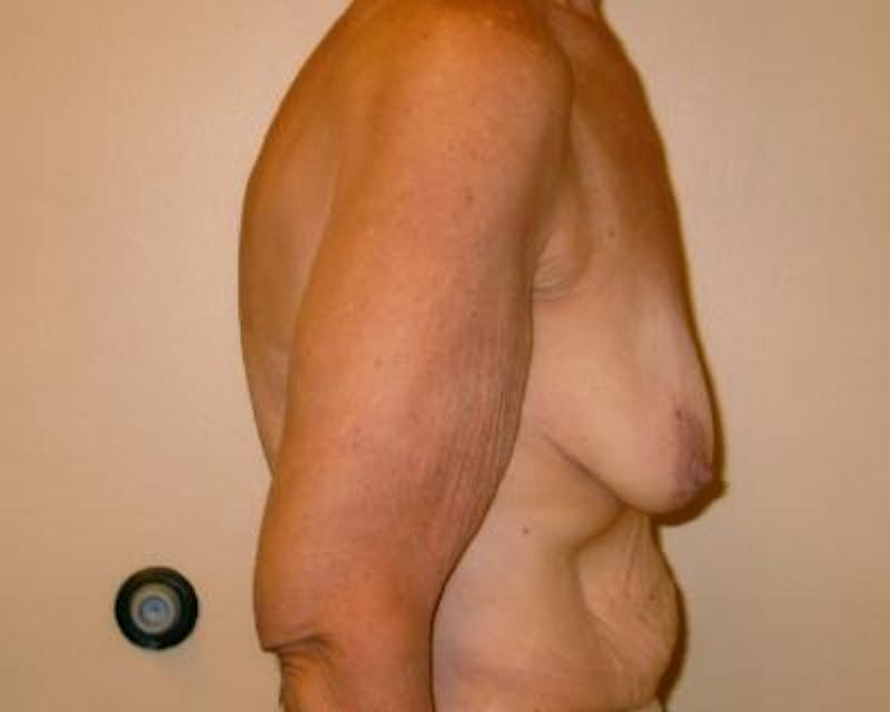 Breast Augmentation With Lift Gallery - Patient 120346191 - Image 3