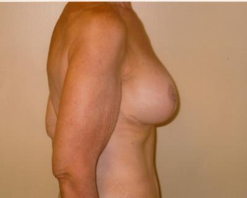 Breast Augmentation With Lift Before & After Gallery - Patient 120346191 - Image 4