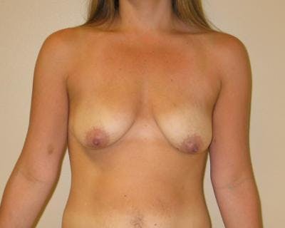 Breast Augmentation With Lift Before & After Gallery - Patient 120346225 - Image 1