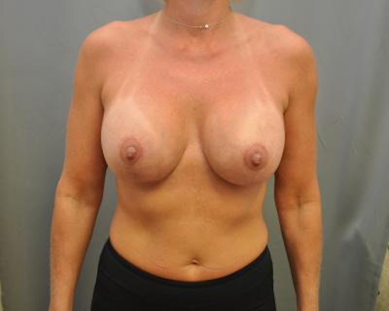 Breast Augmentation With Lift Gallery - Patient 120346282 - Image 2