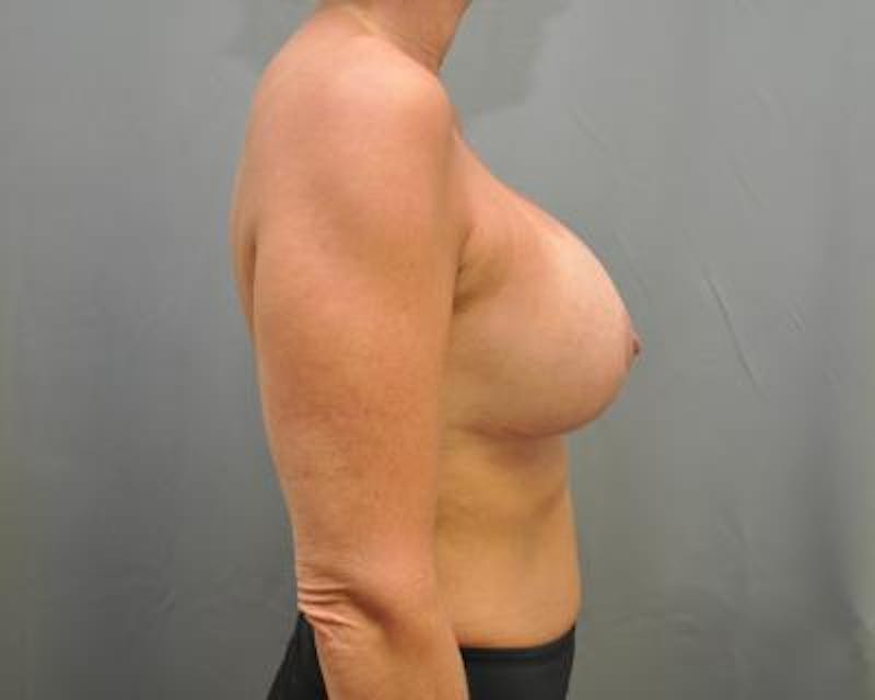 Breast Augmentation With Lift Gallery - Patient 120346282 - Image 4