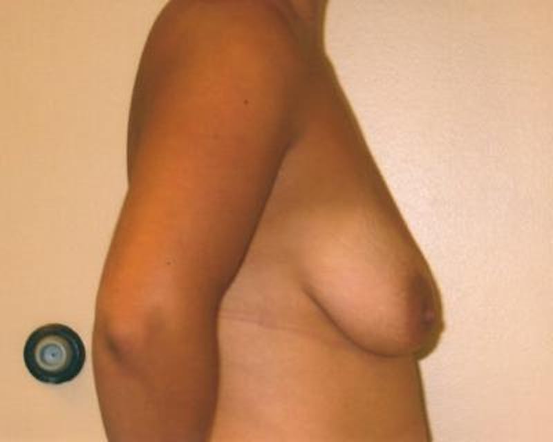 Breast Augmentation With Lift Gallery - Patient 120346284 - Image 3