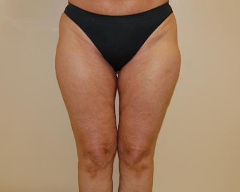 Liposuction