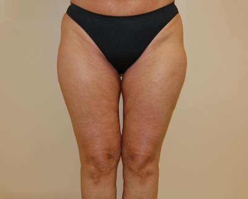Liposuction Gallery - Patient 120346621 - Image 1