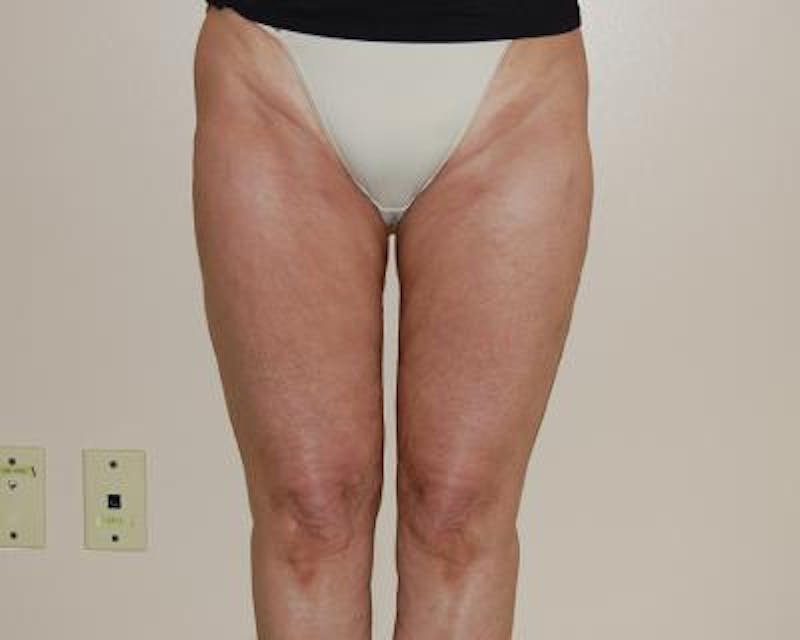 Liposuction