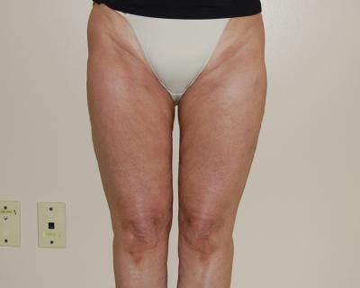 Liposuction Gallery - Patient 120346621 - Image 2