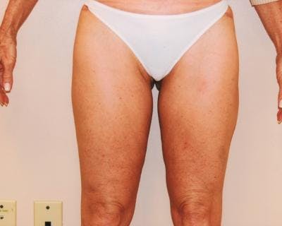 Liposuction Before & After Gallery - Patient 120346632 - Image 2
