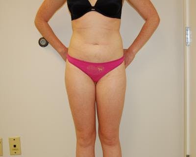 Liposuction Before & After Gallery - Patient 120346638 - Image 2