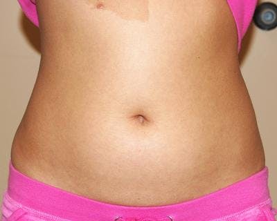 Liposuction Before & After Gallery - Patient 120346641 - Image 1
