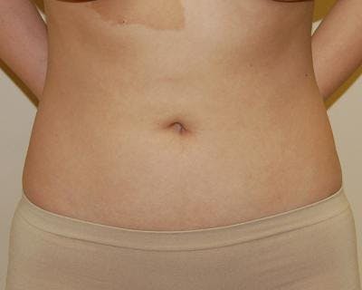 Liposuction Before & After Gallery - Patient 120346641 - Image 2