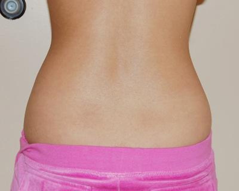Liposuction Before & After Gallery - Patient 120346641 - Image 3