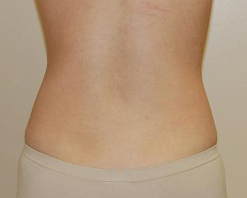 Liposuction Before & After Gallery - Patient 120346641 - Image 4