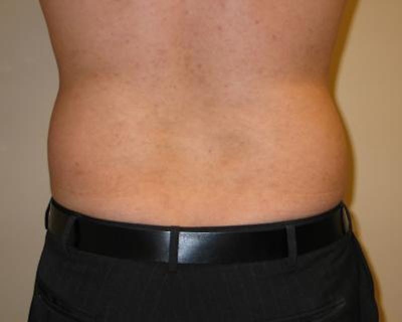 Liposuction Gallery - Patient 120346648 - Image 1