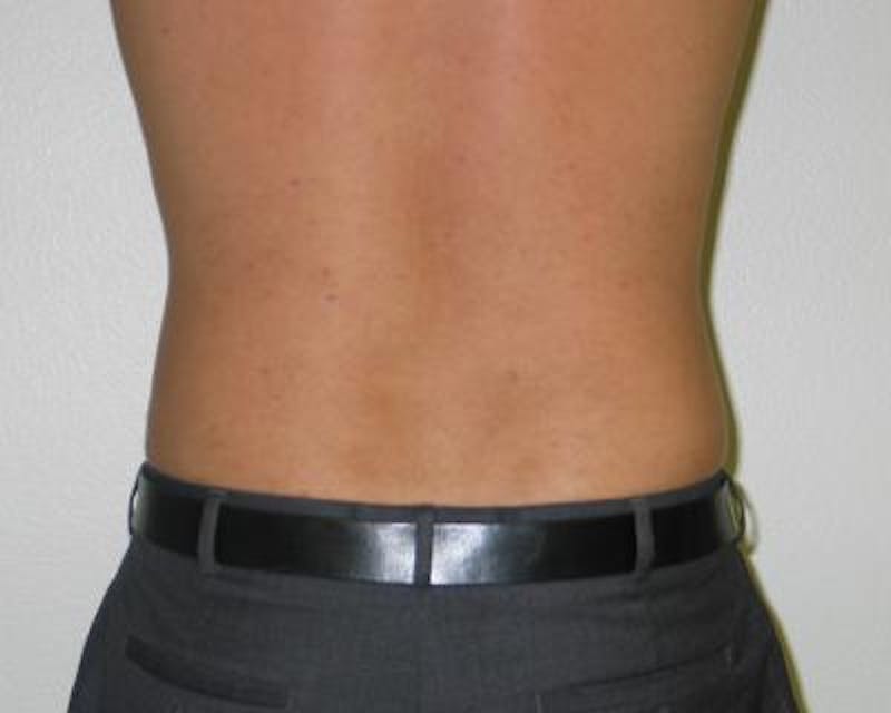 Liposuction Before & After Gallery - Patient 120346648 - Image 2
