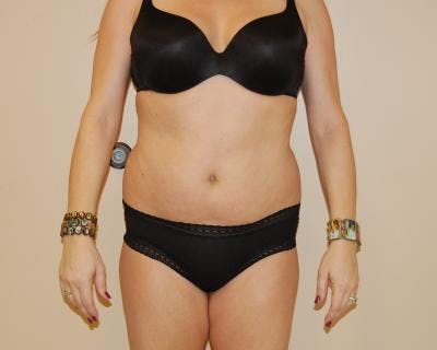 Liposuction Before & After Gallery - Patient 120346650 - Image 1